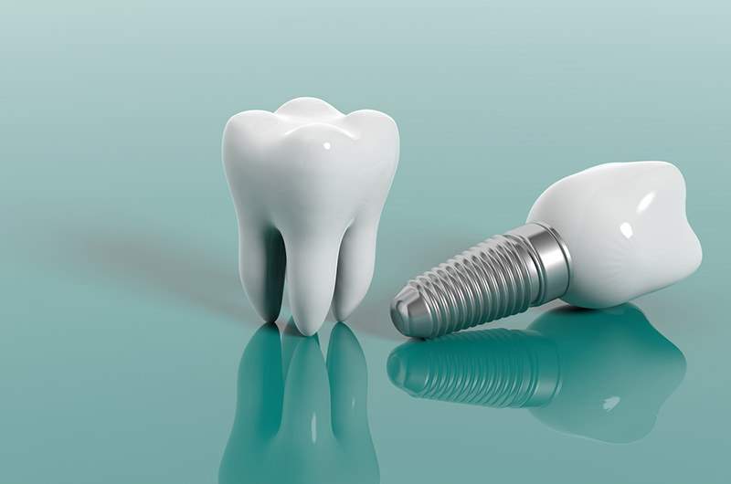 失った歯の機能を回復するインプラント
