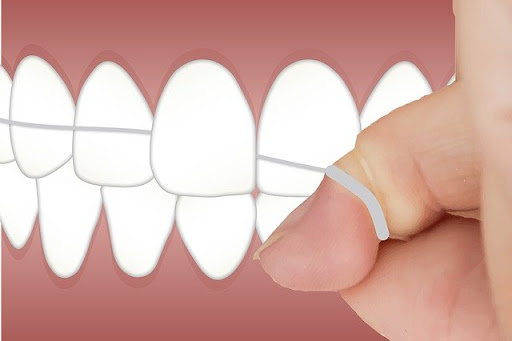 虫歯予防は「細菌感染」を防ぐこと