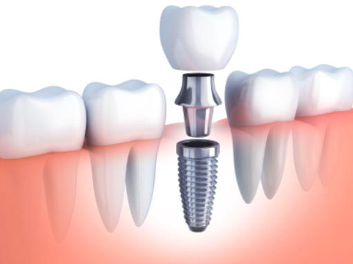 インプラント、入れ歯、ブリッジの特徴を解説。どれがおすすめ？